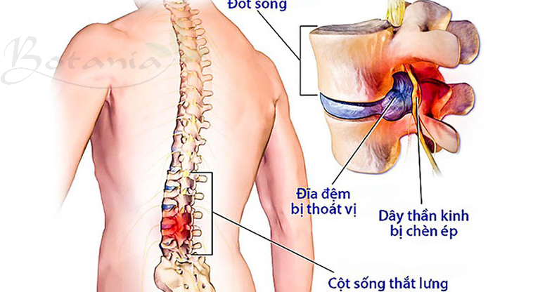 Bệnh thoát vị đĩa đệm